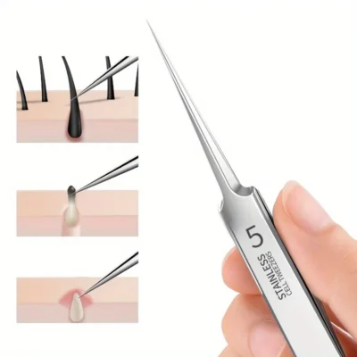 Clear Skin Stainless Steel Tweezers - Acne & Blackhead Removal, Hypoallergenic, For All Skin Types